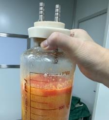 河南水动力吸脂手术要做多久？